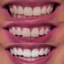 the first diy teeth whitening gel with the led activated peroxide used by dentis