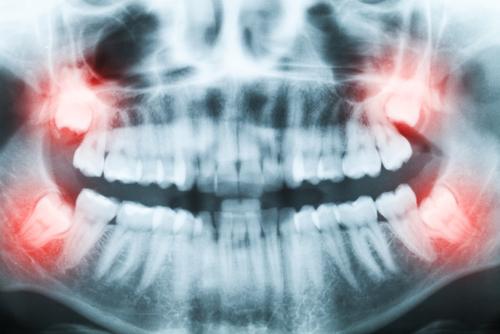 ever wonder why we have wisdom teeth coafs explains the details