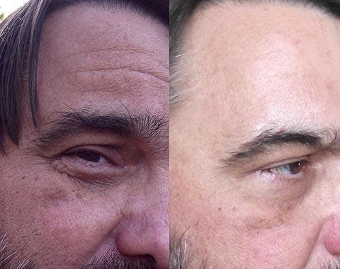 get the best alexandria la wrinkle removal anti aging red light led treatments