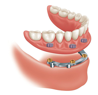 grow your dental implant business with a specialist practice growth system